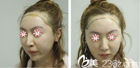 去貴陽美貝爾整形醫(yī)院前的我 去貴陽美貝爾整形醫(yī)院前的我