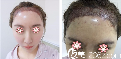 廖小飛主任給我手術(shù)當(dāng)天 廖小飛主任給我手術(shù)當(dāng)天