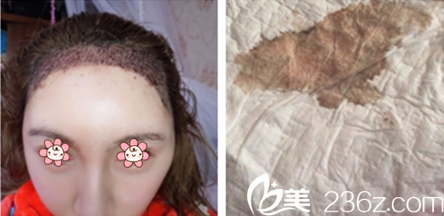 廖小飛發(fā)際線種植術(shù)后第二天 廖小飛發(fā)際線種植術(shù)后第二天