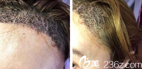 貴陽美貝爾發(fā)際線種植術(shù)后9天 貴陽美貝爾發(fā)際線種植術(shù)后9天