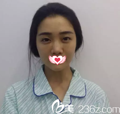 術(shù)前鼻子塌平 術(shù)前鼻子塌平