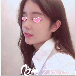 我親身體驗北京京美硅膠假體隆鼻綜合效果感覺挺靠譜價格也公道