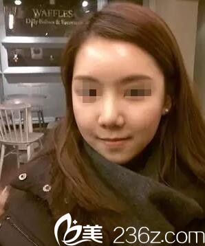 看我在南寧芯玥做自體脂肪面部填充術(shù)后輕松擁有女神范