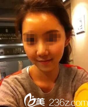 南寧美麗星做自體脂肪面部填充術(shù)13天 南寧美麗星做自體脂肪面部填充術(shù)13天