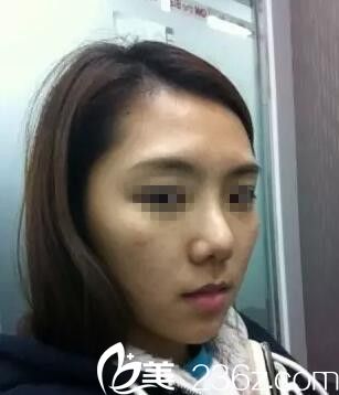 南寧美麗星做豐太陽穴+臉頰自體填充手術(shù) 南寧美麗星做豐太陽穴+臉頰自體填充手術(shù)