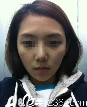 南寧美麗星做自體脂肪面部填充手術(shù) 南寧美麗星做自體脂肪面部填充手術(shù)