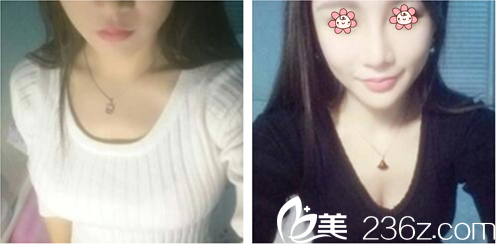 張寶譽(yù)假體隆胸術(shù)后半個(gè)月