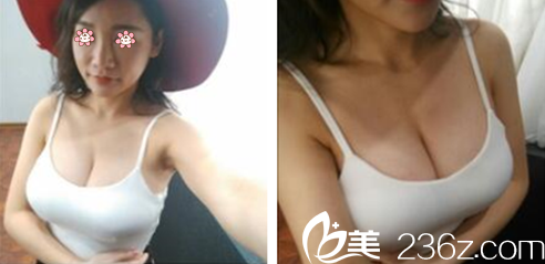 烏魯木齊伊麗莎白整形假體豐胸術(shù)后一個(gè)月