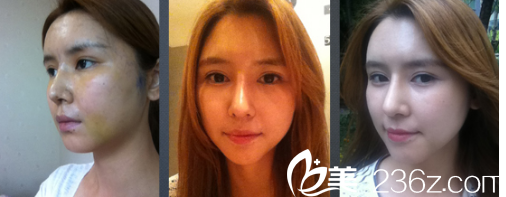 術(shù)后恢復(fù)的第10天