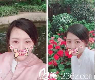 看我在洛陽(yáng)愛(ài)尚做的雙眼皮手術(shù)恢復(fù)照 第二天拿掉紗布就去上班