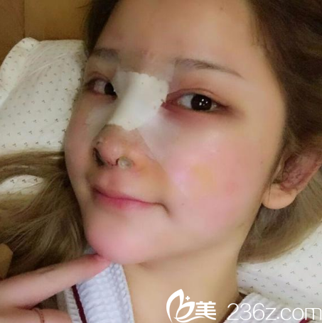 來廣州星團(tuán)找黃立斌剛做完隆鼻的圖片 來廣州星團(tuán)找黃立斌剛做完隆鼻的圖片