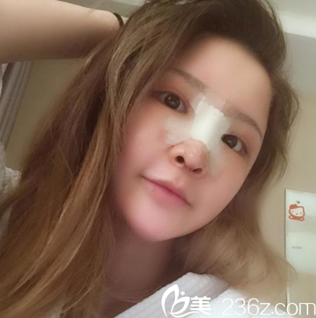 找廣州星團(tuán)黃立斌院長做完隆鼻三天恢復(fù)圖片 找廣州星團(tuán)黃立斌院長做完隆鼻三天恢復(fù)圖片