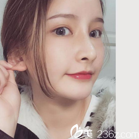 之前在廣州星團(tuán)整形醫(yī)院做過(guò)雙眼皮這次來(lái)找黃立斌院長(zhǎng)做鼻綜合隆鼻
