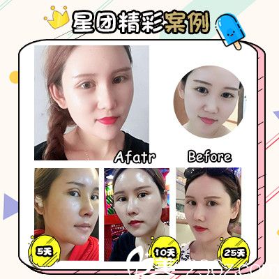 廣州星團(tuán)整形醫(yī)院黃立斌做的鼻綜合隆鼻案例圖 廣州星團(tuán)整形醫(yī)院黃立斌做的鼻綜合隆鼻案例圖