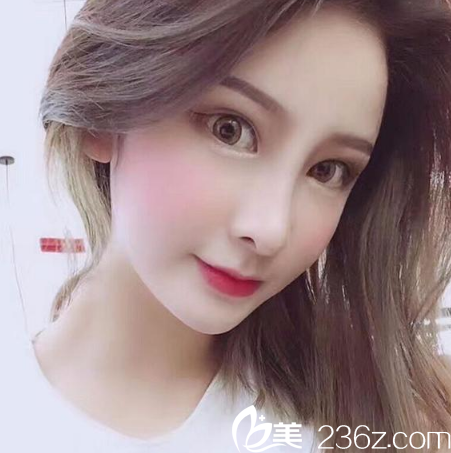 廣州星團(tuán)整形醫(yī)院黃立斌鼻綜合隆鼻案例兩個(gè)月效果圖 廣州星團(tuán)整形醫(yī)院黃立斌鼻綜合隆鼻案例兩個(gè)月效果圖