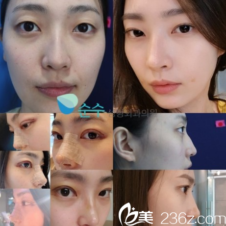 崔宰源院長雙眼皮隆鼻效果好嗎