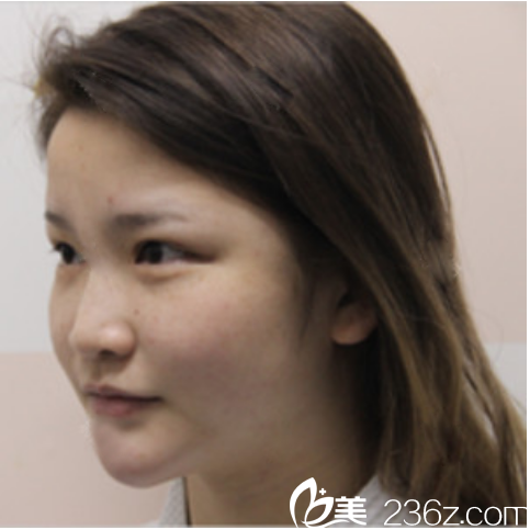 來廣州星團(tuán)找黃立斌院長隆鼻前的照片 來廣州星團(tuán)找黃立斌院長隆鼻前的照片