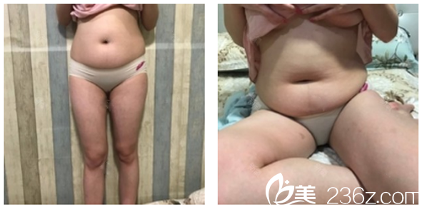 來廣州星團整形醫(yī)院做吸脂前的照片 來廣州星團整形醫(yī)院做吸脂前的照片