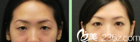 韓國Prima整形外科醫(yī)院祛眼袋案例