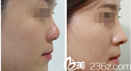 韓國Prima整形外科醫(yī)院硅膠隆鼻效果