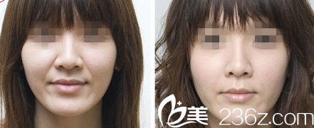 韓國Prima整形外科醫(yī)院面部除皺效果