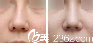 韓國Prima整形外科醫(yī)院郭赫俊歪鼻矯正效果 韓國Prima整形外科醫(yī)院郭赫俊歪鼻矯正效果