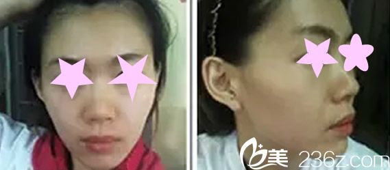 自體軟骨隆鼻手術前照片