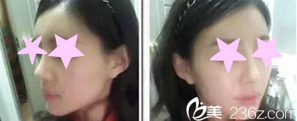 channel整形外科醫(yī)院自體軟骨隆鼻手術兩個月后恢復效果