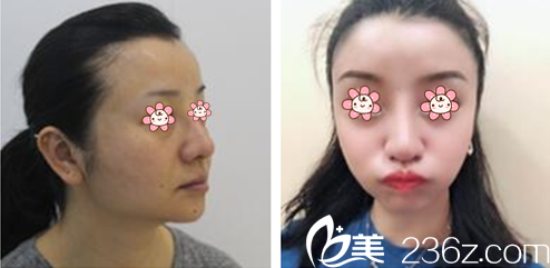 金仁哲院長面部輪廓案例