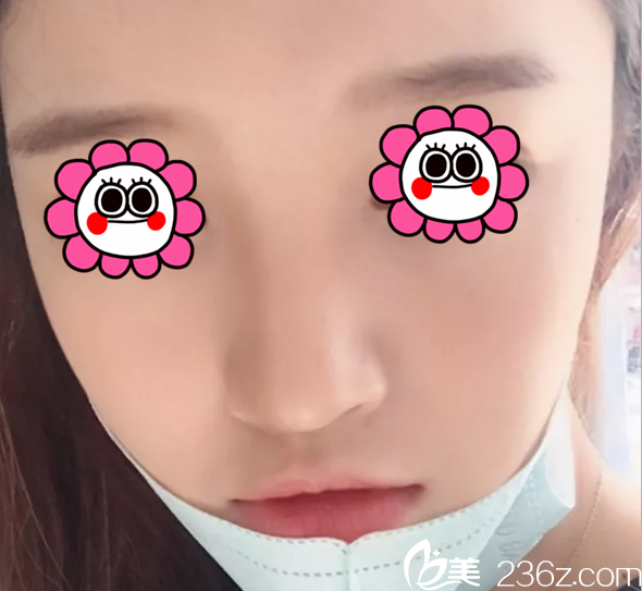 郭赫俊鼻綜合案例第21天效果 郭赫俊鼻綜合案例第21天效果