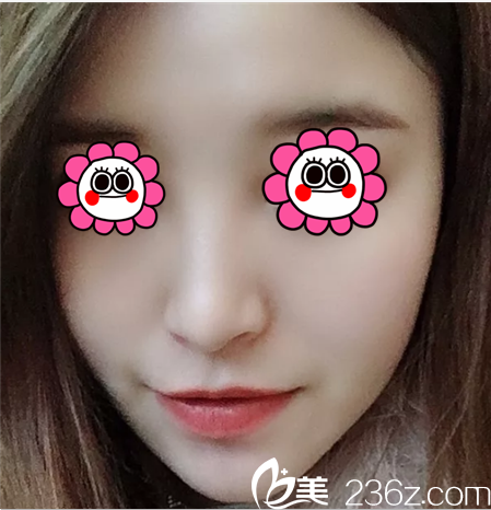 給你看我在韓國Prima整形醫(yī)院找郭赫俊做肋軟骨鼻綜合第57天效果