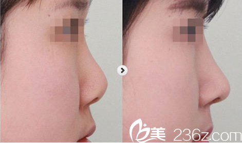 隆鼻手術案例對比圖