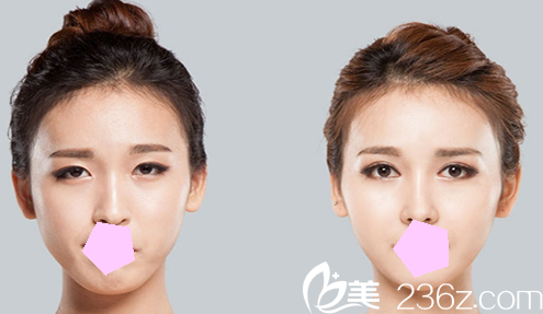 太原華美<!--<i data=20240703-sp></i>-->雙眼皮失敗修復(fù)前后效果對比圖 太原華美<!--<i data=20240703-sp></i>-->雙眼皮失敗修復(fù)前后效果對比圖