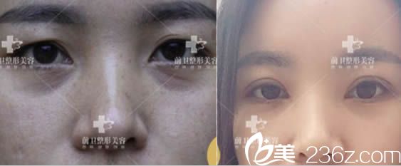 宜昌整形美容雙眼皮效果對比圖 宜昌整形美容雙眼皮效果對比圖