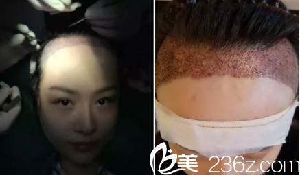 發(fā)際線種植后第10天的樣子