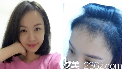 發(fā)際線種植后兩個(gè)月的樣子
