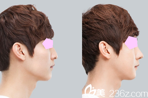 太原華美整形趙景鵬注射隆鼻前后效果對(duì)比圖