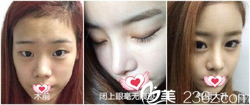 齊向暉院長做埋線雙眼皮案例