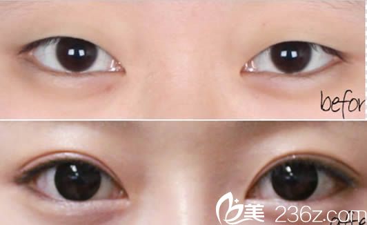 貴陽(yáng)美貝爾醫(yī)療美容雙眼皮案例圖
