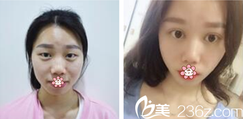 姜哲旭院長雙眼皮案例 姜哲旭院長雙眼皮案例