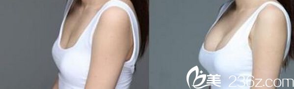 吉基賢院長(zhǎng)自體隆胸效果案例 吉基賢院長(zhǎng)自體隆胸效果案例