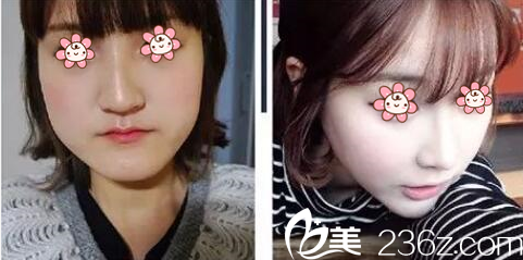 孫佑佶院長面部輪廓案例 孫佑佶院長面部輪廓案例