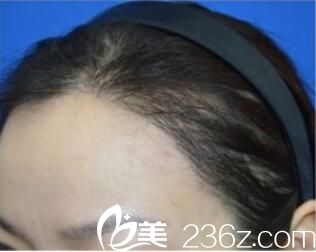 曬曬我在韓國洪承哲找洪承哲做發(fā)際線種植術前術后對比圖