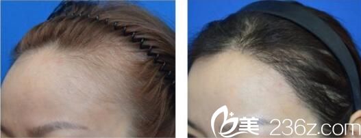 韓國洪承哲整形外科洪承哲發(fā)際線種植真人案例術(shù)前術(shù)后對比