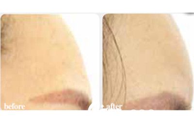 韓國(guó)延世羅姿麗整形醫(yī)院豐額頭案例 韓國(guó)延世羅姿麗整形醫(yī)院豐額頭案例