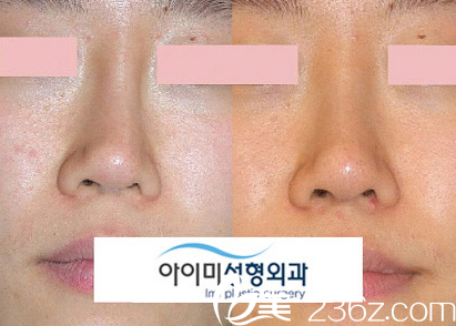 韓國愛美(IMI)整形醫(yī)院歪鼻矯正案例對比圖 韓國愛美(IMI)整形醫(yī)院歪鼻矯正案例對比圖