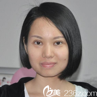 深圳富華切開雙眼皮七天拆線效果圖