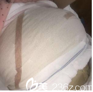 在<!--<i data=20240703-sp></i>-->做脂肪豐胸第2天效果