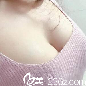 <!--<i data=20240703-sp></i>-->脂肪豐胸案例第31天效果