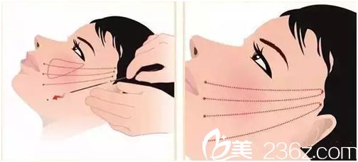 面部埋線提升抗衰